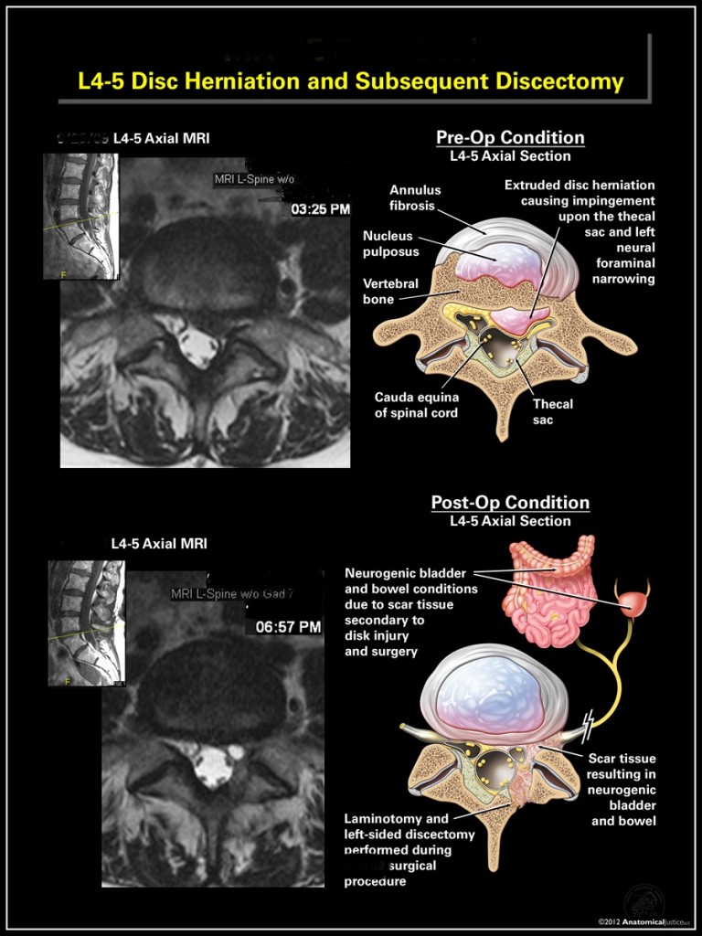 Herniated Disc Example